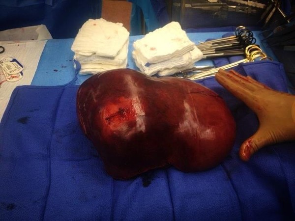 The initial tumor (17lbs.) that I carried during pregnancy.  The doctors and I were unaware of the tumor.
