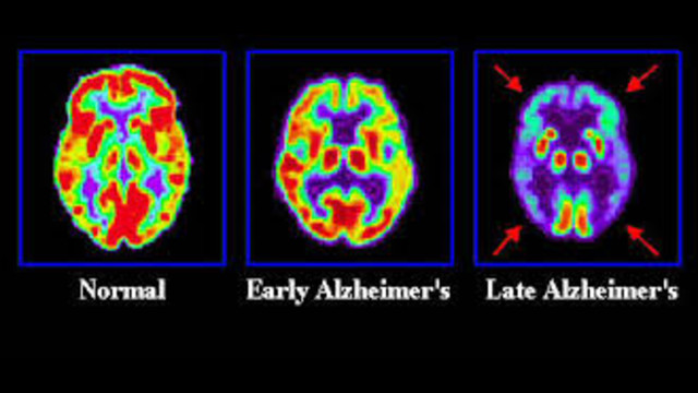 dementia alzheimer s disease and person essay dementia alzheimer s disease and person essay