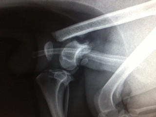 Distal Femoral Fracture w Knee Displacement