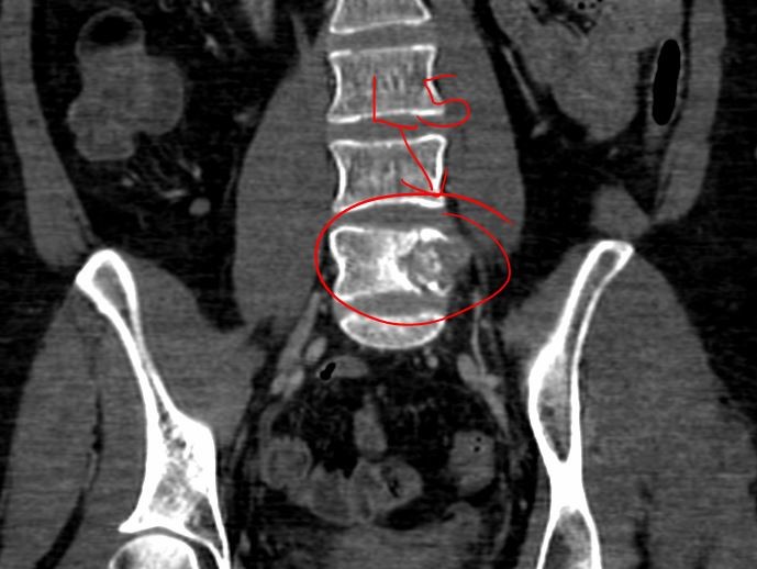 spinal cord cancer located in L5