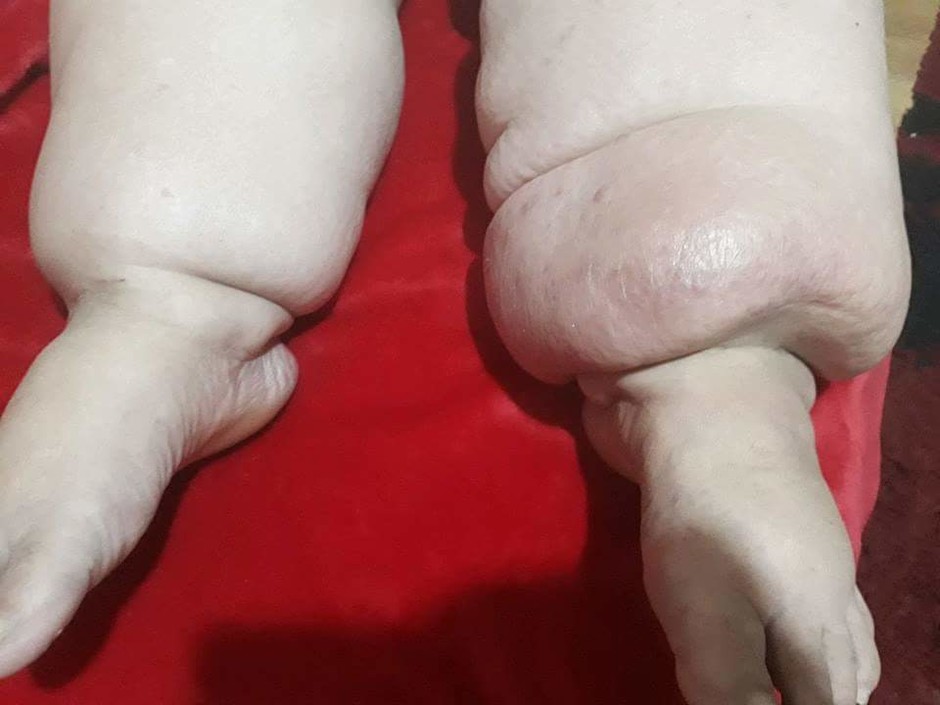 The mother's swollen legs