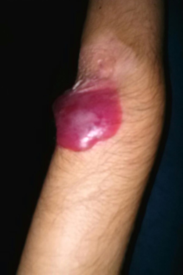 left elbow this is just one of the things Davion struggles with while suffering from EB