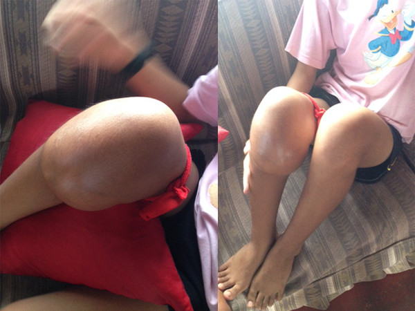 Around early May 2014, the tumor on her knee has grown this big.