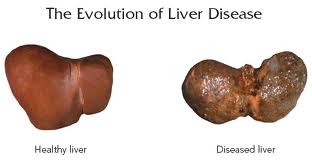 Healthy Liver VS Diseased Liver