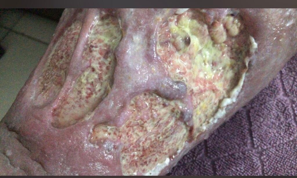 Infection