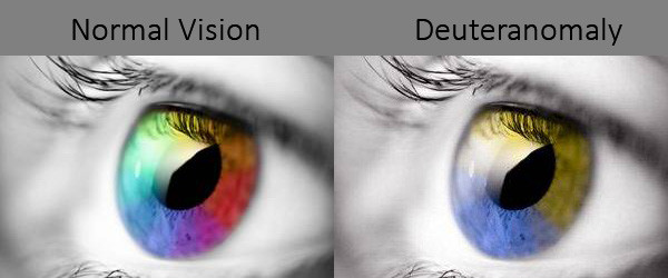 Comparison between Deuteranomaly and normal color vision.