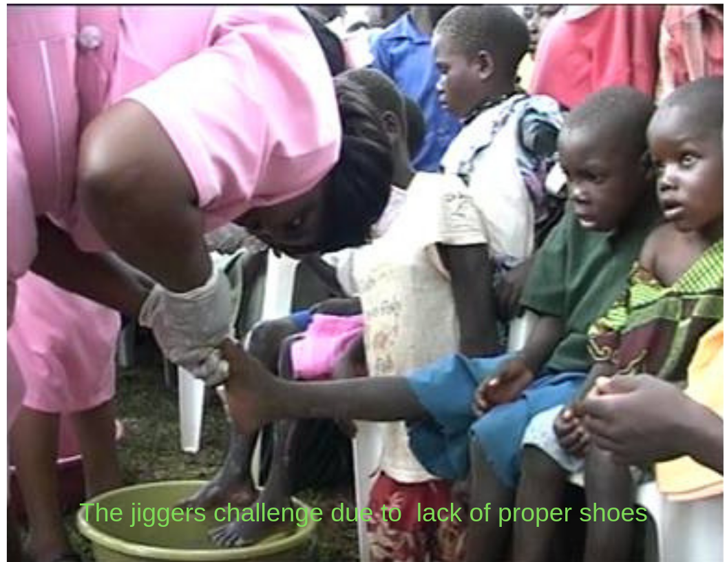 treating children from jiggers and some of the causes are due to lack of shoes-rich alt text