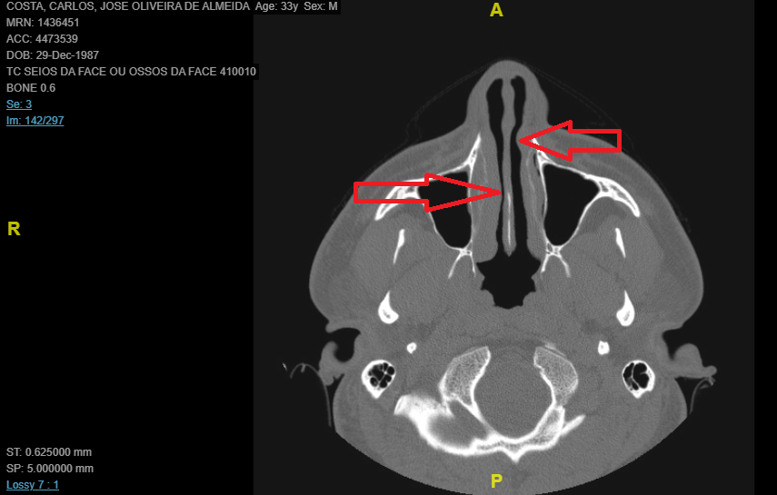 Deviated septum with 100% left nostril blockage