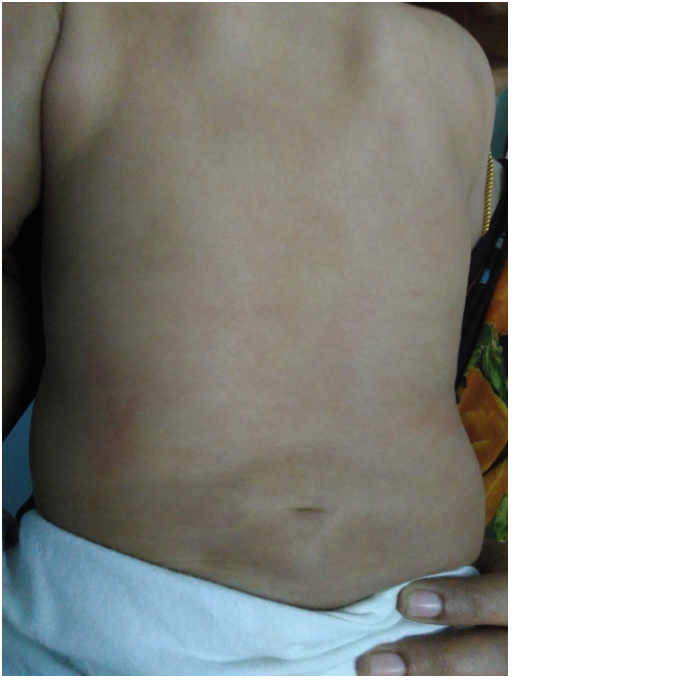 Lipoma on the lower back