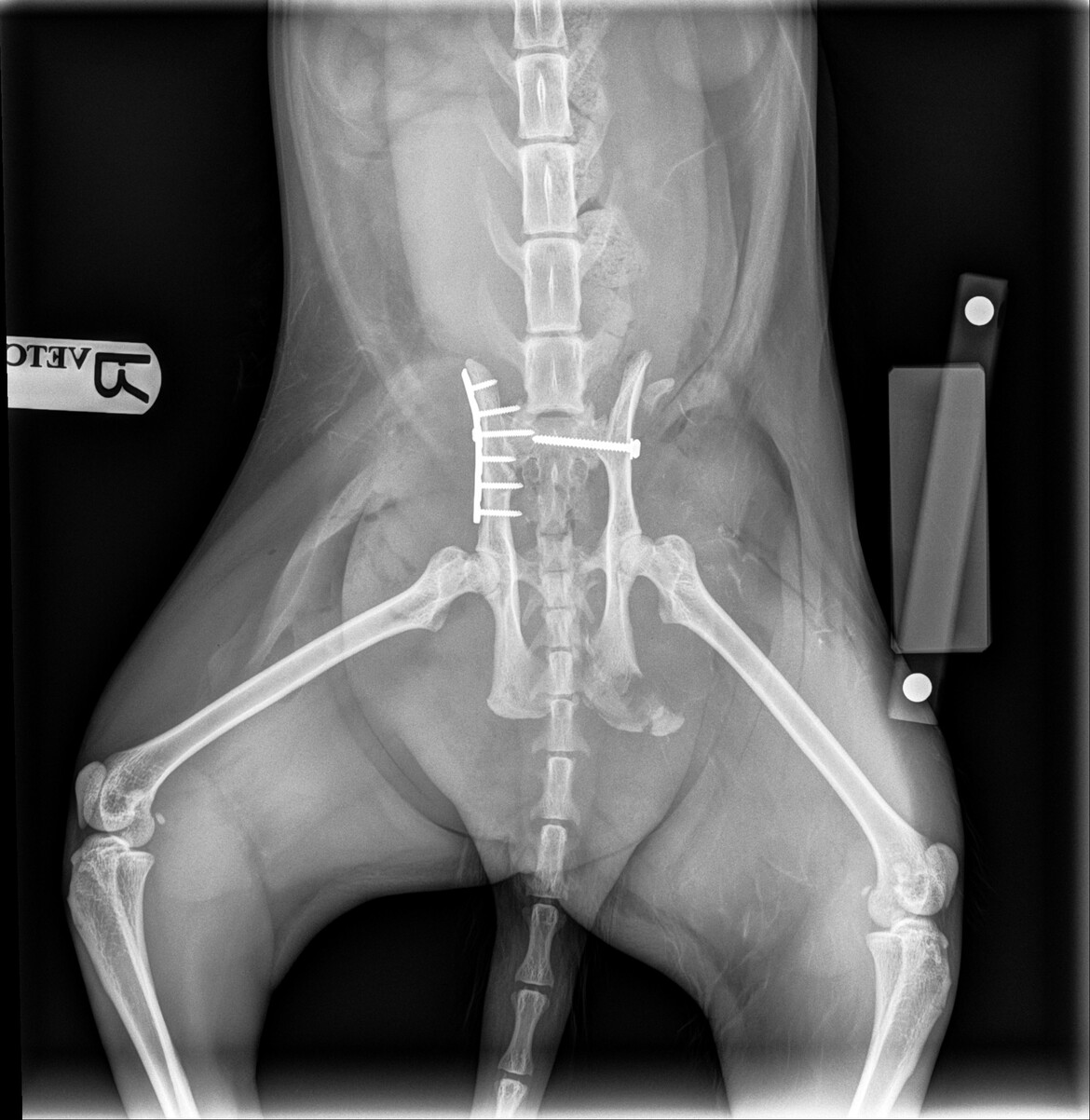 After surgery Xray 6 screws + 1 metal plate on left side and 1 big screw on right side