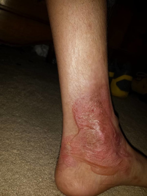 Davion's ankle from his shoes rubbing against it