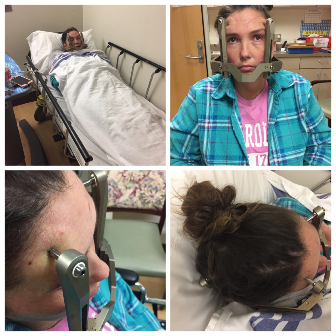 Gama Knife Radiation Surgery