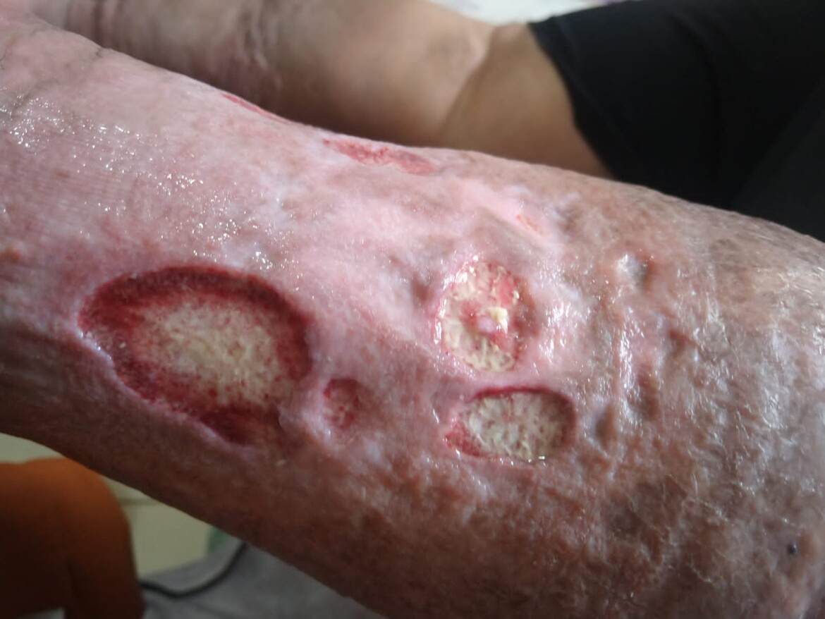 Infection 3