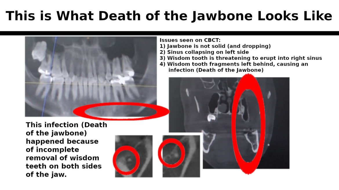 (This is what death of the jawbone looks like)