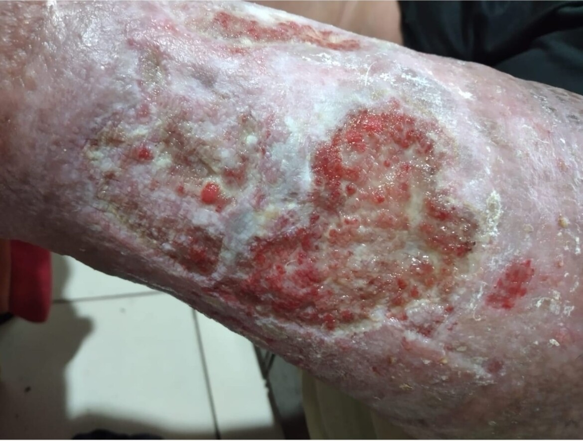 Infection 2