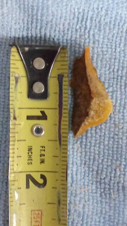 Bone chip removed from Faith today