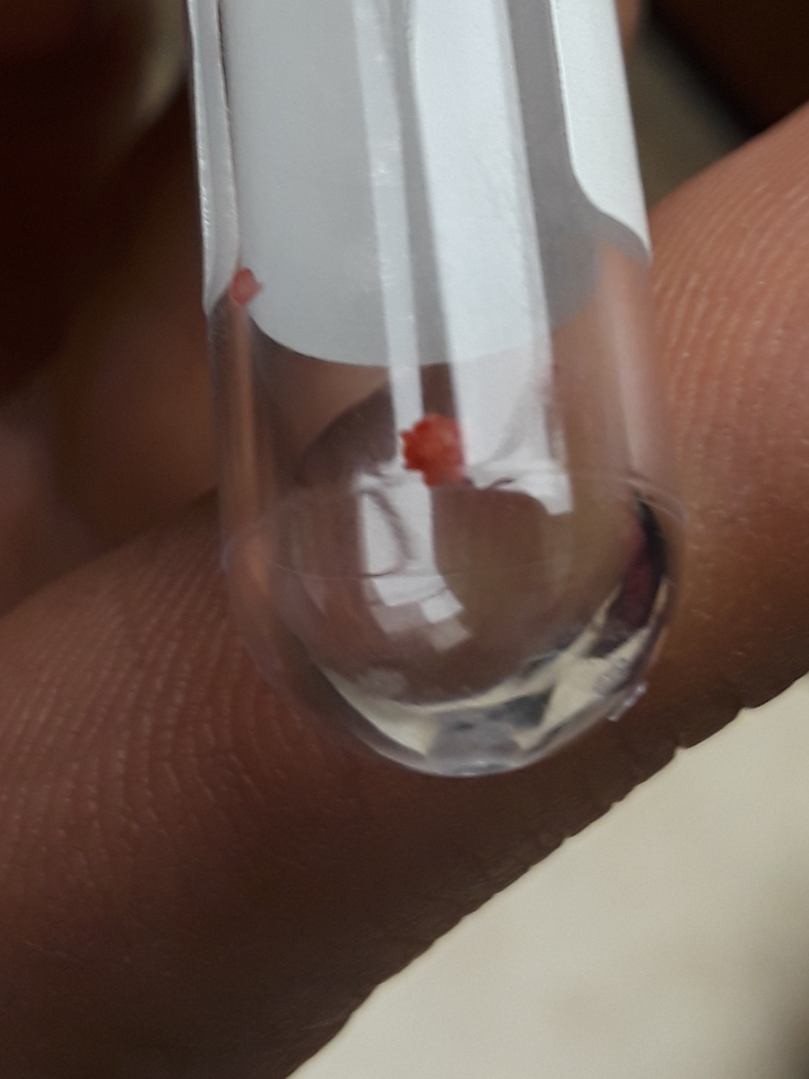 Teeny tiny cystine stone that was obstructing