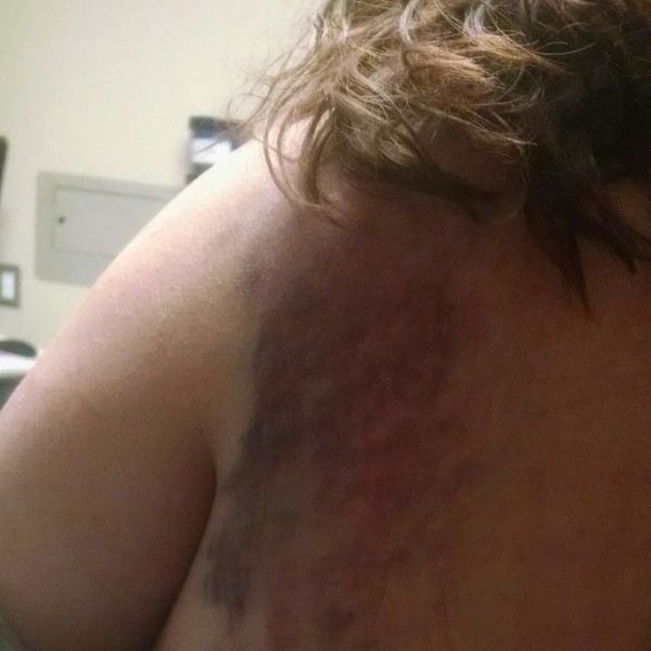 broken scapula and ribs