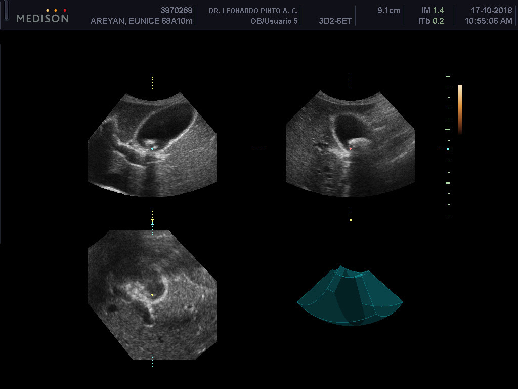 ecosonogram showing the gallstone