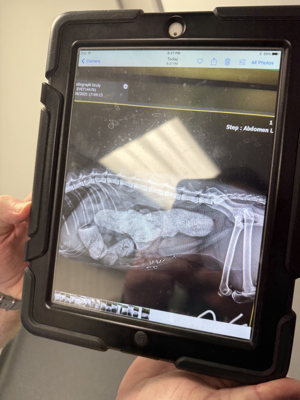 Severe impaction of fecal