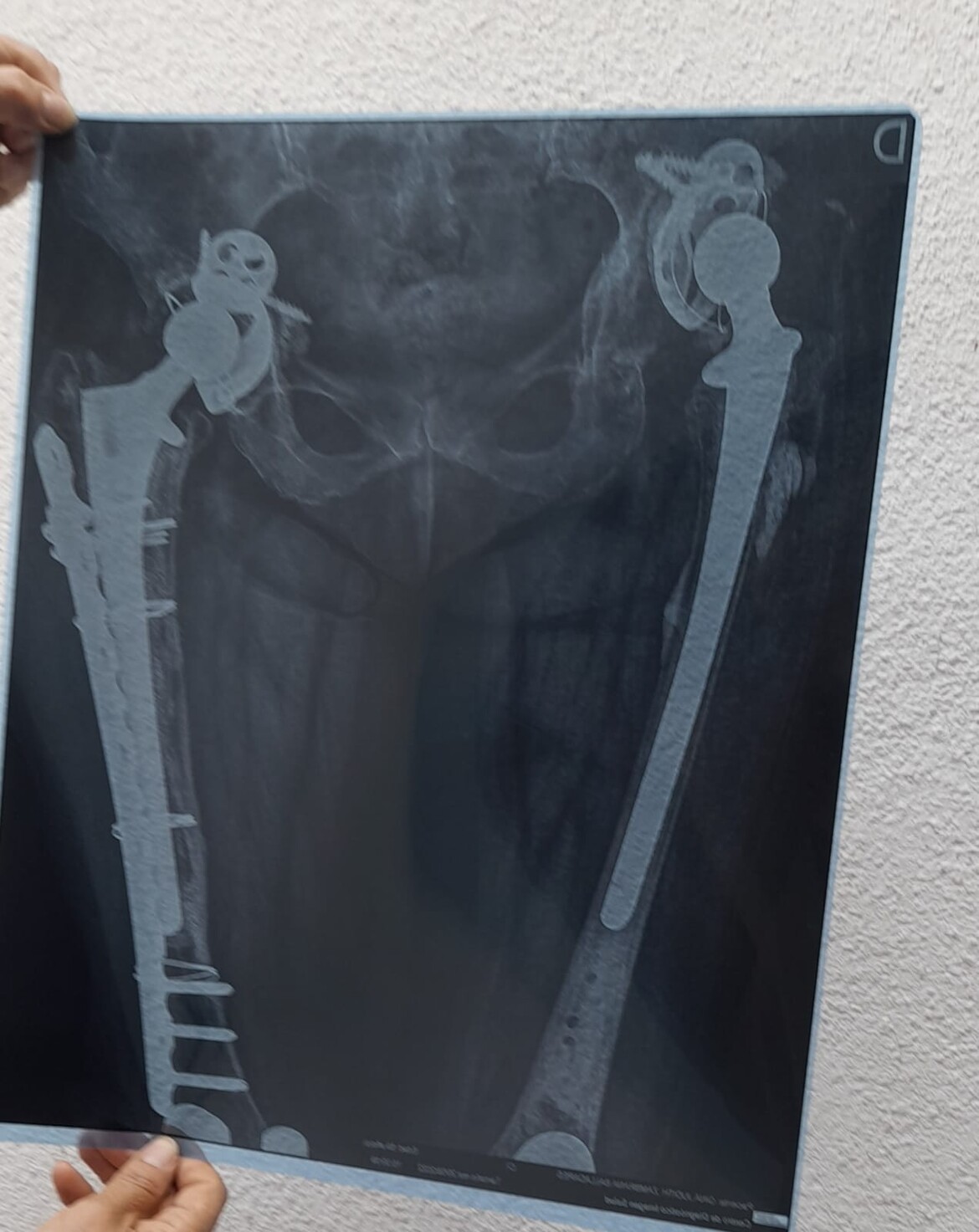 Damaged hip replacement radiography