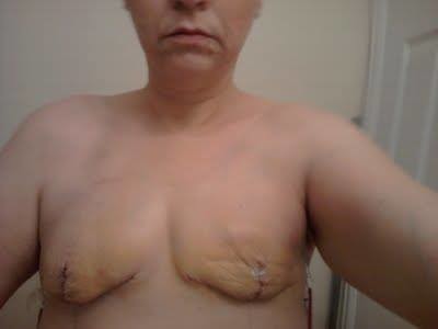 after bilateral mastectomy (sorry TMI) but it is the ugly truth
