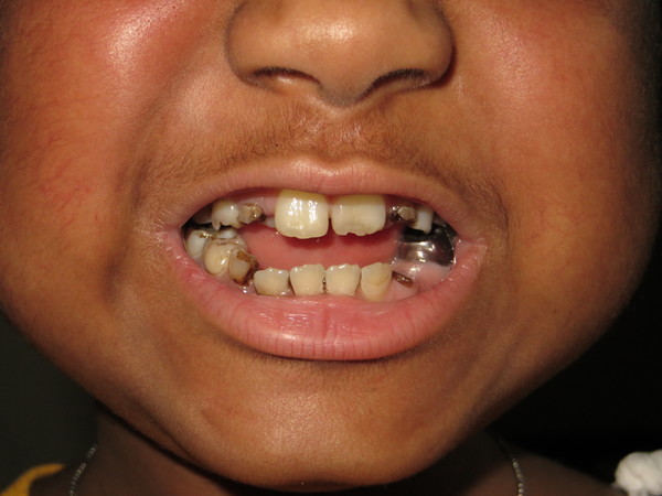 Zion teeth decay
