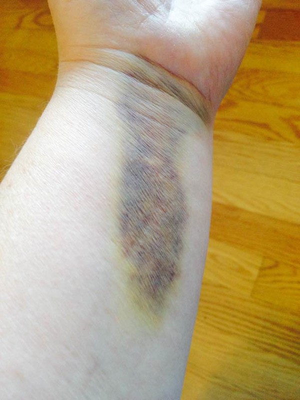 My wrist, SEVEN WEEKS later