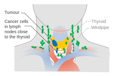 Stage N1a cancer of the thyroid
