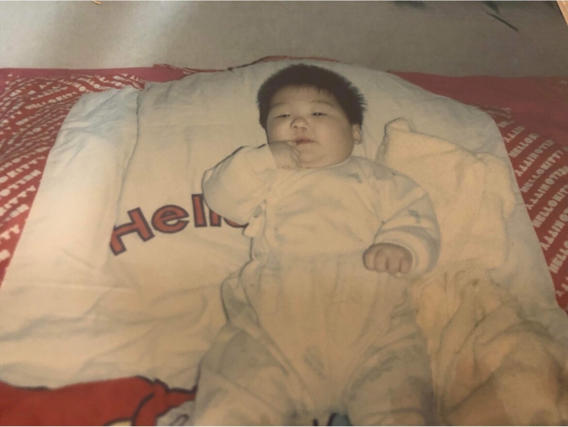 My mom lost the picture of me upon birth. This is the picture of showing my left cleft was sewed up .